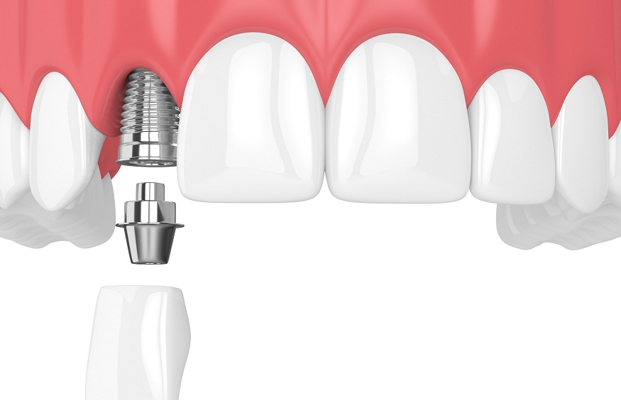 dental prosthesis