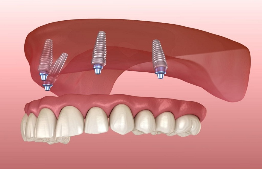 dental prosthesis